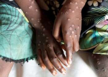Ghana records 107 Mpox cases