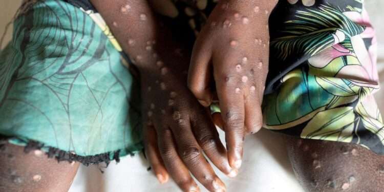 Ghana records 107 Mpox cases