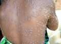 Ghana Mpox cases Health